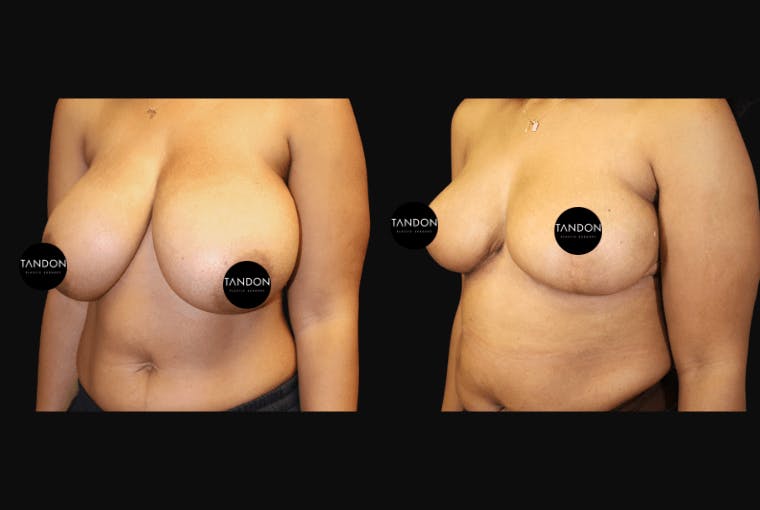 Breast Reduction Before & After Gallery - Patient 103021 - Image 4
