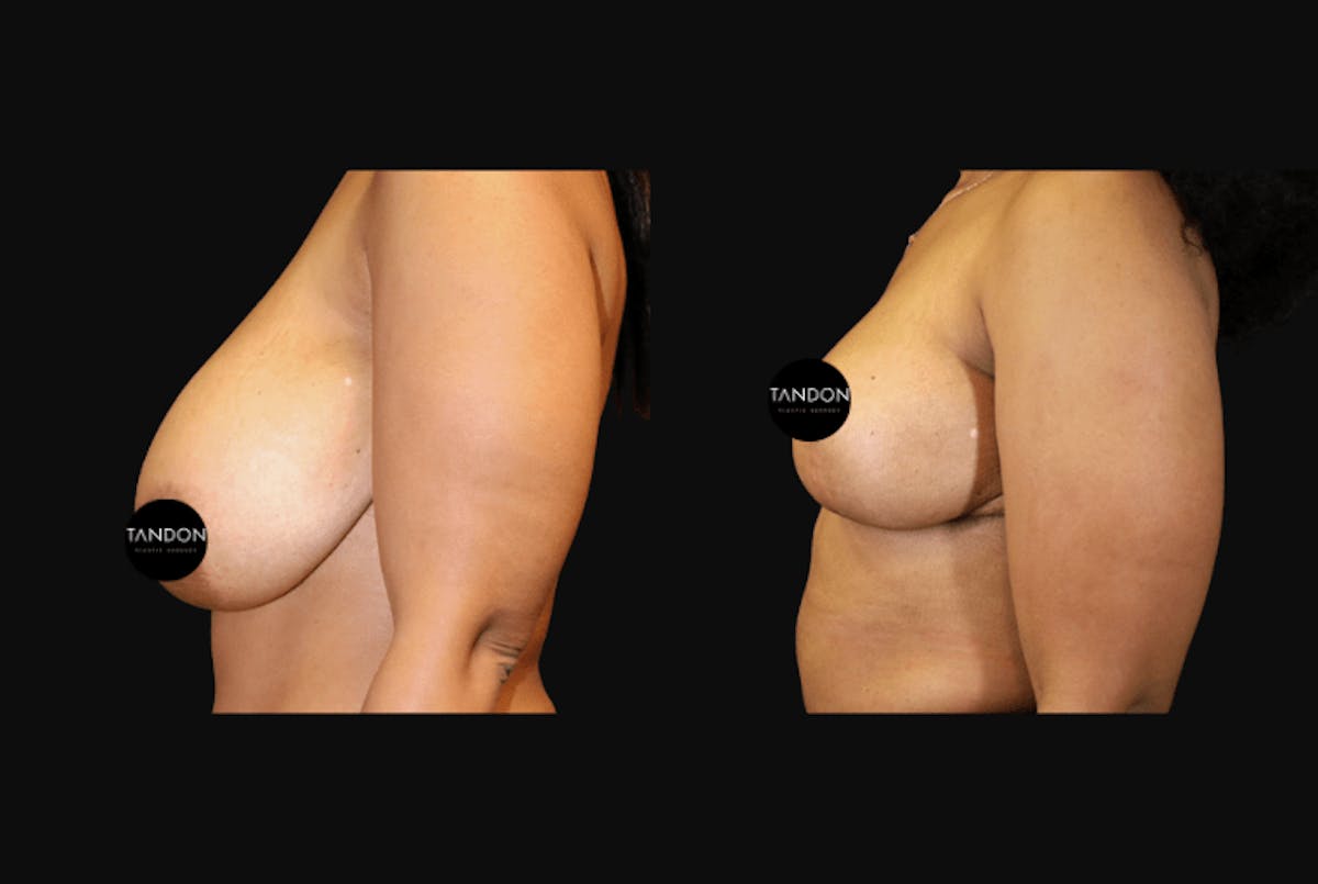 Breast Reduction Before & After Gallery - Patient 103021 - Image 3