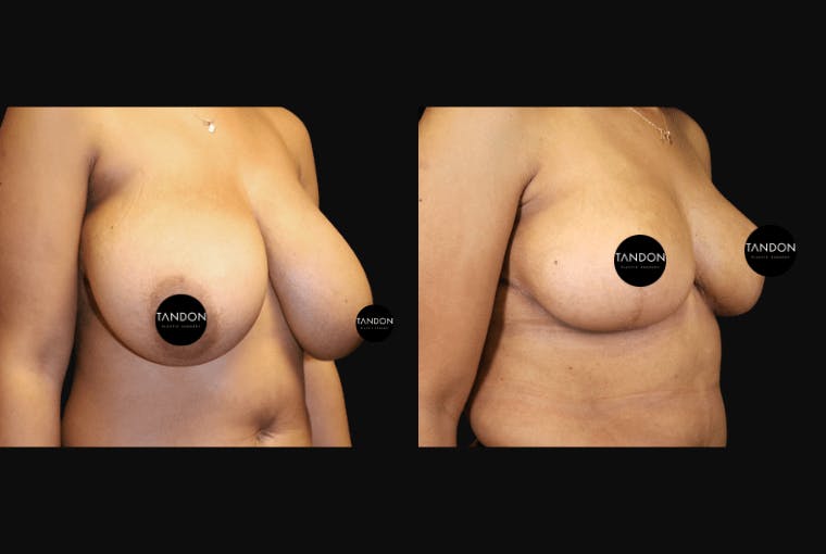 Breast Reduction Before & After Gallery - Patient 103021 - Image 5