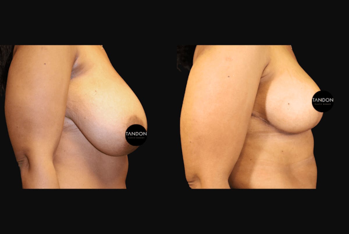 Breast Reduction Before & After Gallery - Patient 103021 - Image 2