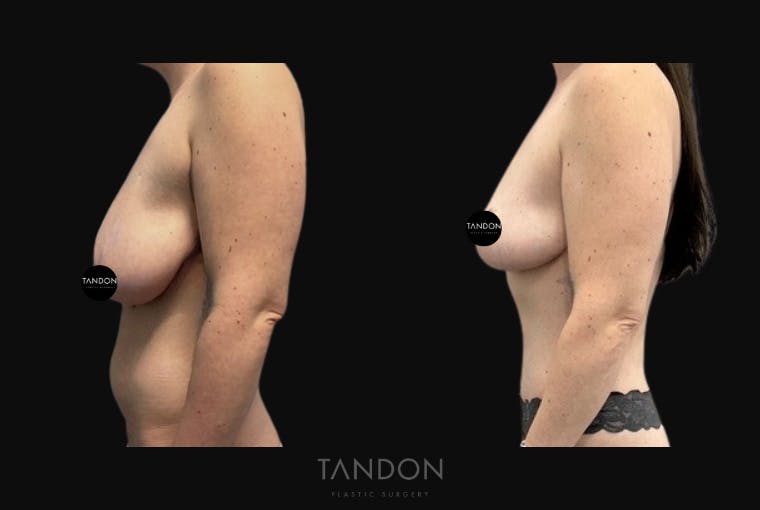 Abdominoplasty (Tummy Tuck) Before & After Gallery - Patient 201957 - Image 2