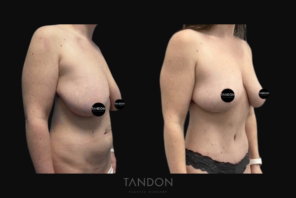Breast Lift Before & After Gallery - Patient 349655 - Image 3
