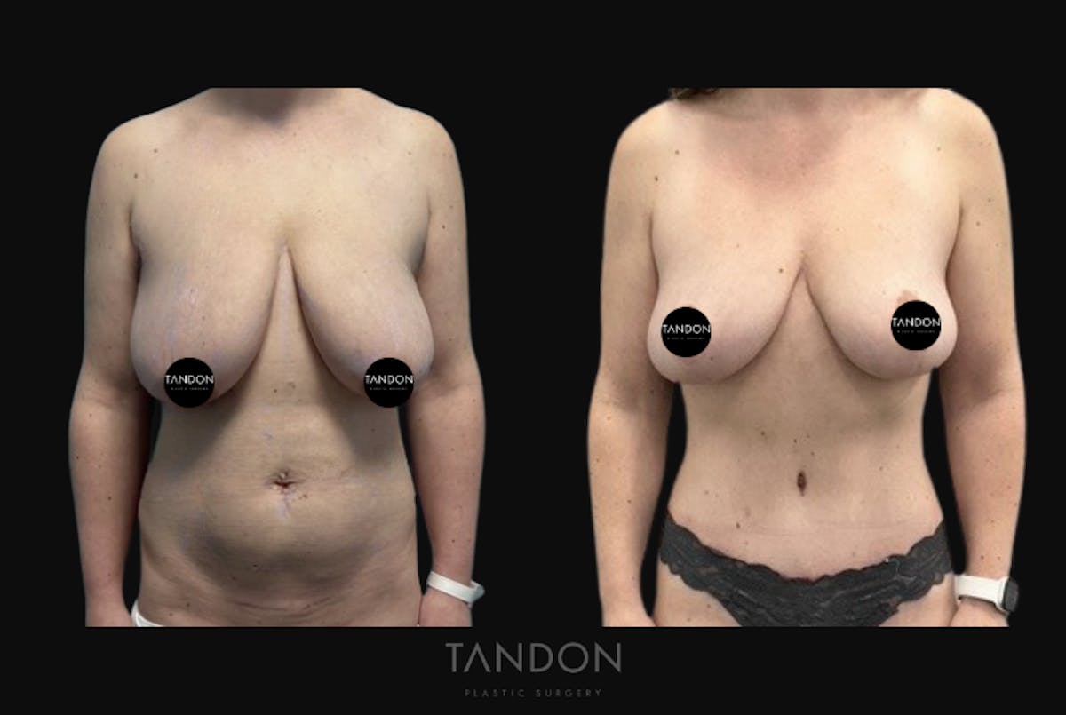 Breast Lift Before & After Gallery - Patient 349655 - Image 1