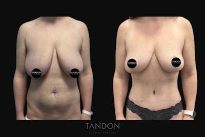 Abdominoplasty (Tummy Tuck) Before & After Gallery - Patient 201957 - Image 1