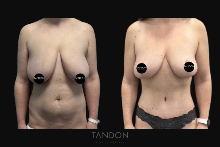 Abdominoplasty (Tummy Tuck) Before & After Gallery - Patient 201957 - Image 1