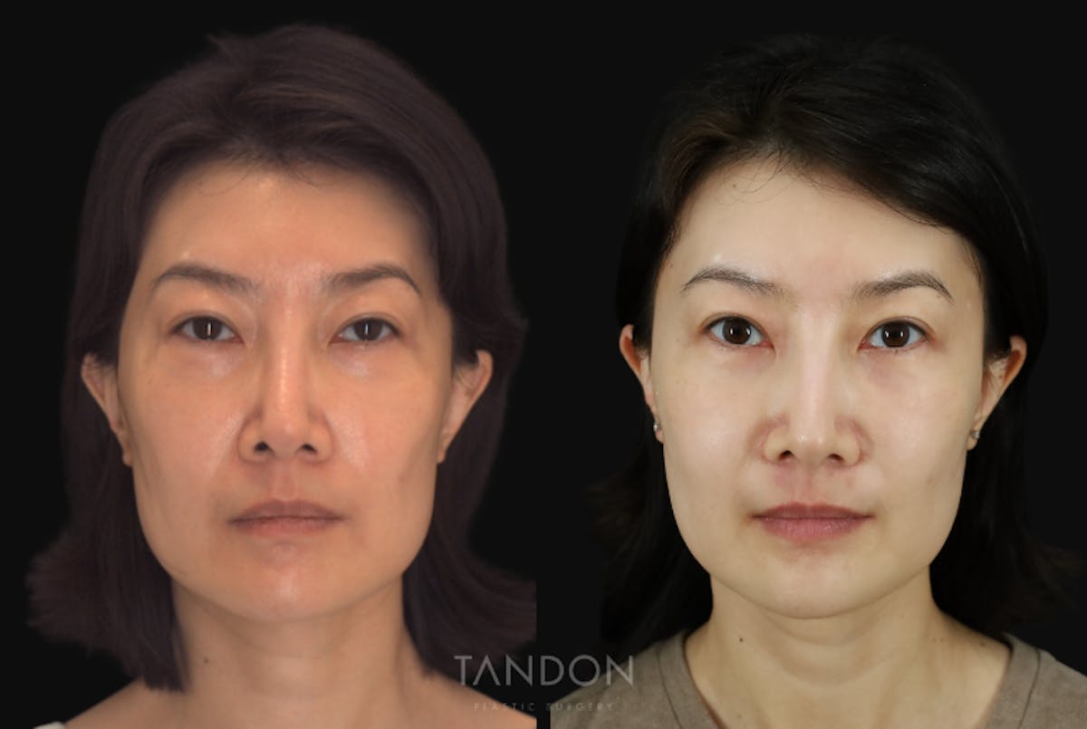 Fat Grafting Before & After Gallery - Patient 262361 - Image 1