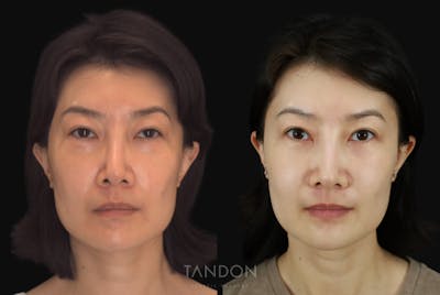 Fat Grafting Before & After Gallery - Patient 262361 - Image 1