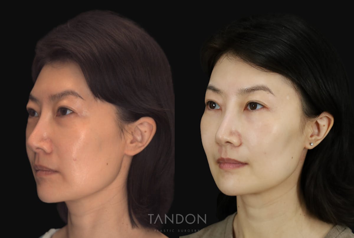 Fat Grafting Before & After Gallery - Patient 262361 - Image 2