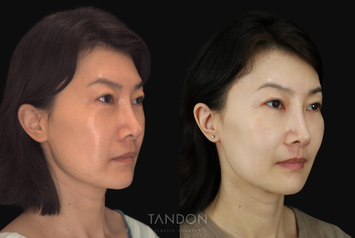 Fat Grafting Before & After Gallery - Patient 262361 - Image 3