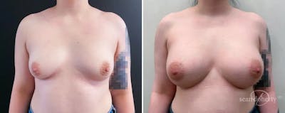 Breast Augmentation Before & After Gallery - Patient 262564 - Image 1
