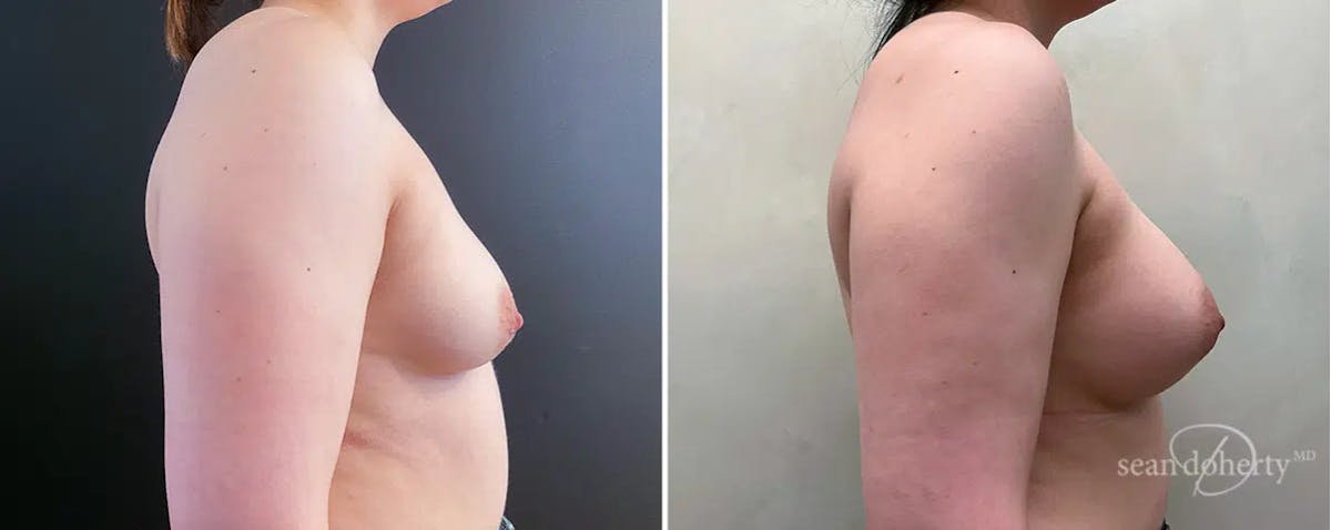 Breast Augmentation  Before & After Gallery - Patient 262564 - Image 2