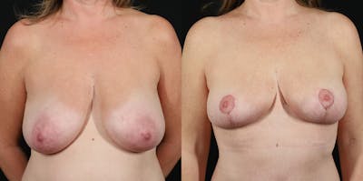 Breast Reduction Before & After Gallery - Patient 855431 - Image 1