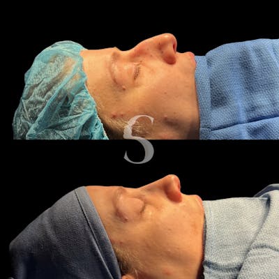 Rhinoplasty Before & After Gallery - Patient 304330 - Image 1