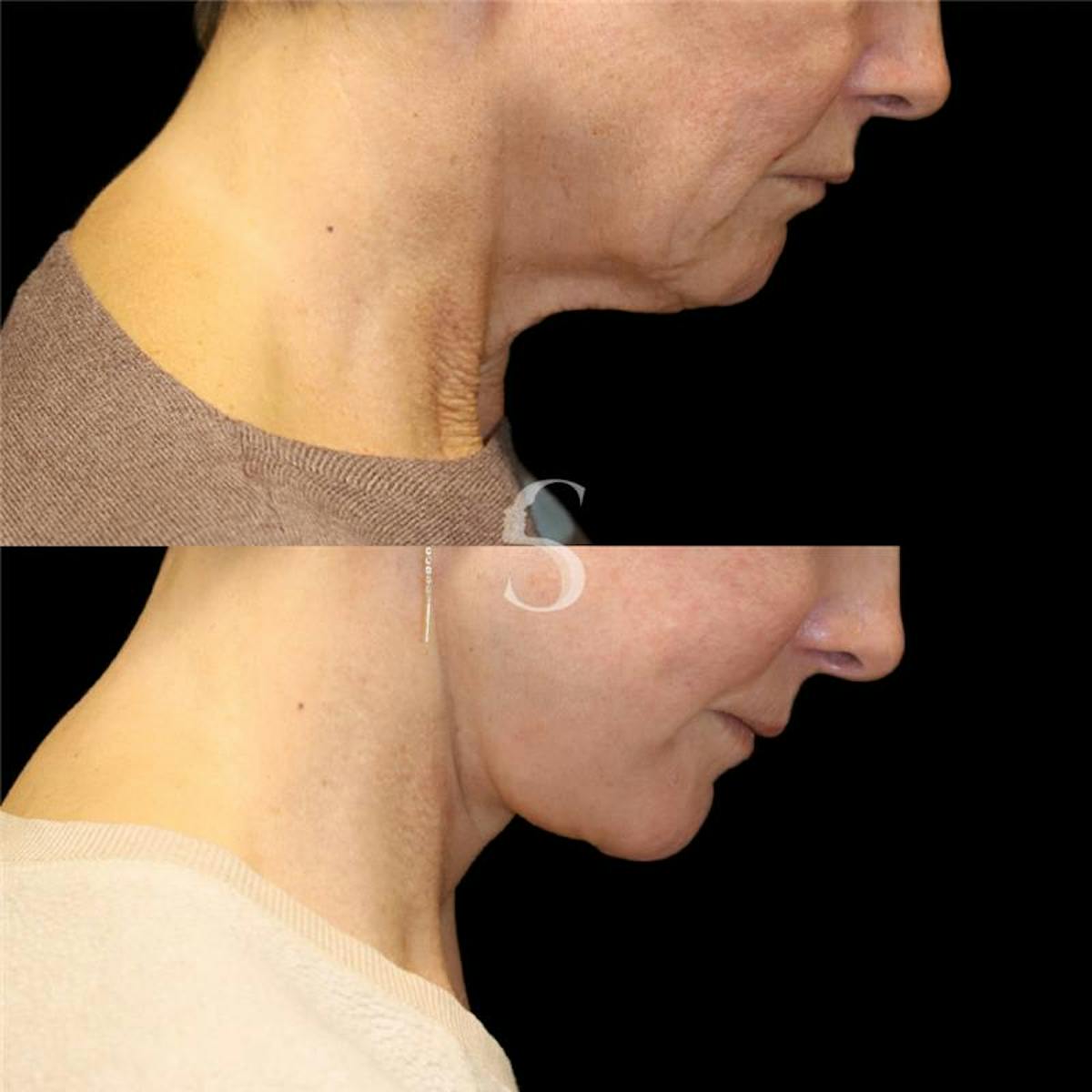 Neck Lift Before & After Gallery - Patient 816909 - Image 3