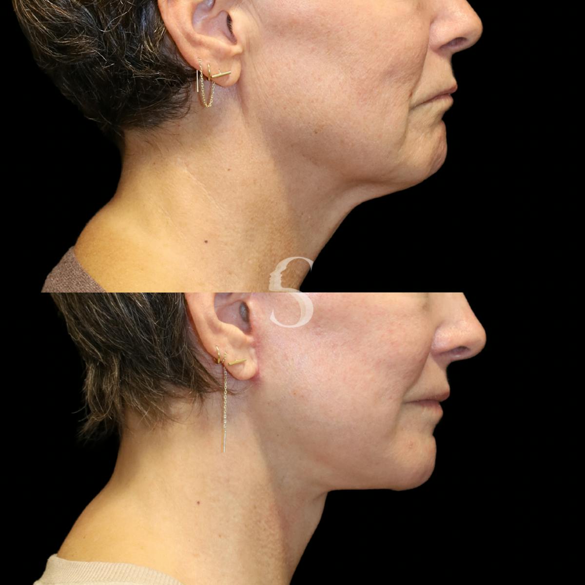 Neck Lift Before & After Gallery - Patient 816909 - Image 2