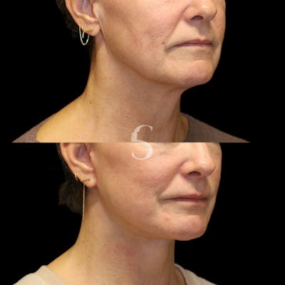 Neck Lift Before & After Gallery - Patient 816909 - Image 1