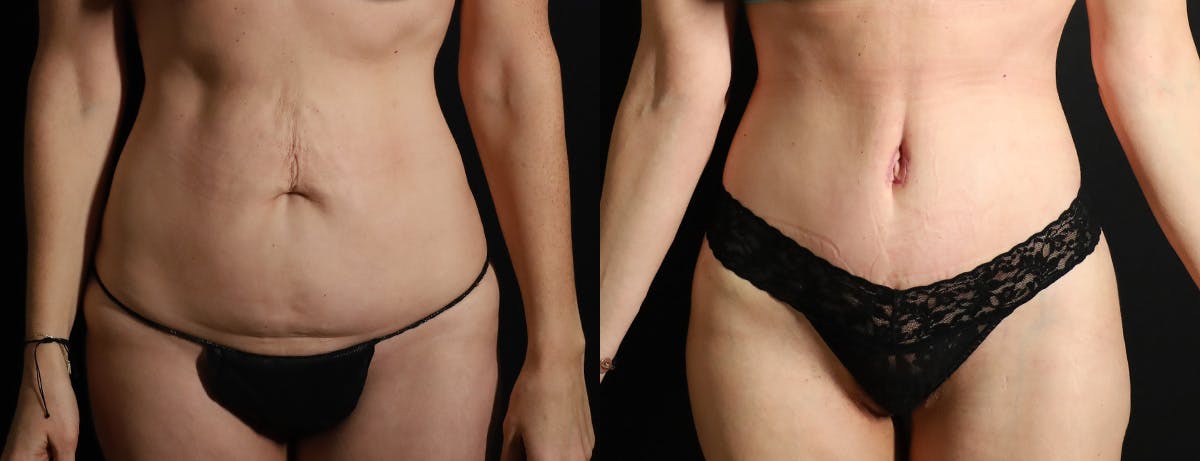 Abdominoplasty (Tummy Tuck) Before & After Gallery - Patient 418188 - Image 1