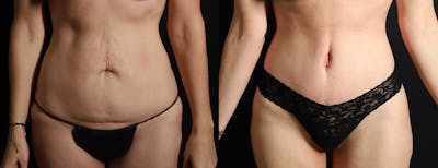 Abdominoplasty (Tummy Tuck) Before & After Gallery - Patient 418188 - Image 1