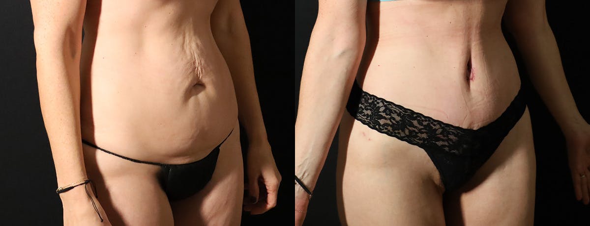 Abdominoplasty (Tummy Tuck) Before & After Gallery - Patient 418188 - Image 2