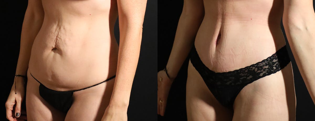 Abdominoplasty (Tummy Tuck) Before & After Gallery - Patient 418188 - Image 3