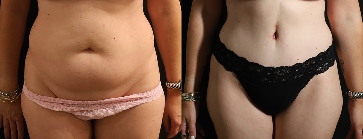 Abdominoplasty (Tummy Tuck) Before & After Gallery - Patient 287356 - Image 1