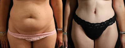 Abdominoplasty (Tummy Tuck) Before & After Gallery - Patient 287356 - Image 1