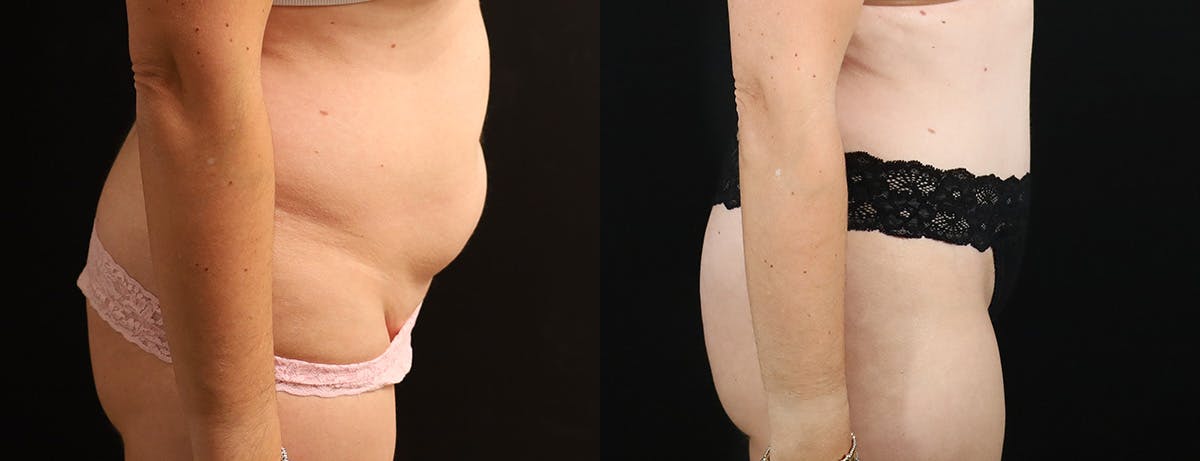 Abdominoplasty (Tummy Tuck) Before & After Gallery - Patient 287356 - Image 3
