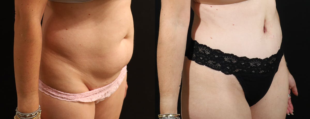 Abdominoplasty (Tummy Tuck) Before & After Gallery - Patient 287356 - Image 2