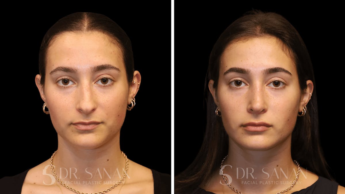 Rhinoplasty Before & After Gallery - Patient 274781 - Image 3