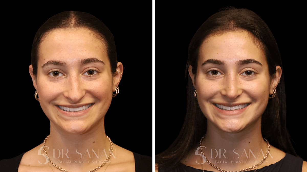 Rhinoplasty Before & After Gallery - Patient 274781 - Image 4