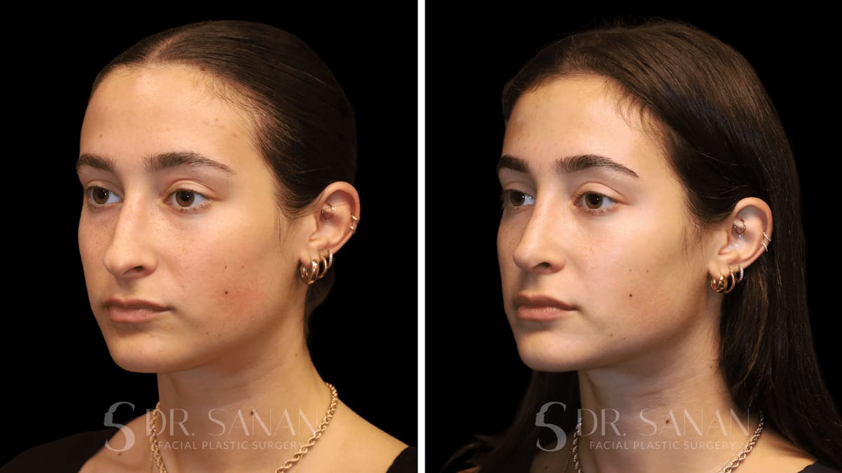 Rhinoplasty Before & After Gallery - Patient 274781 - Image 5