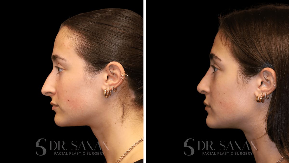 Rhinoplasty Before & After Gallery - Patient 274781 - Image 2