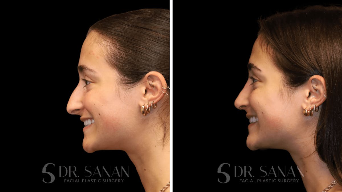 Rhinoplasty Before & After Gallery - Patient 274781 - Image 7