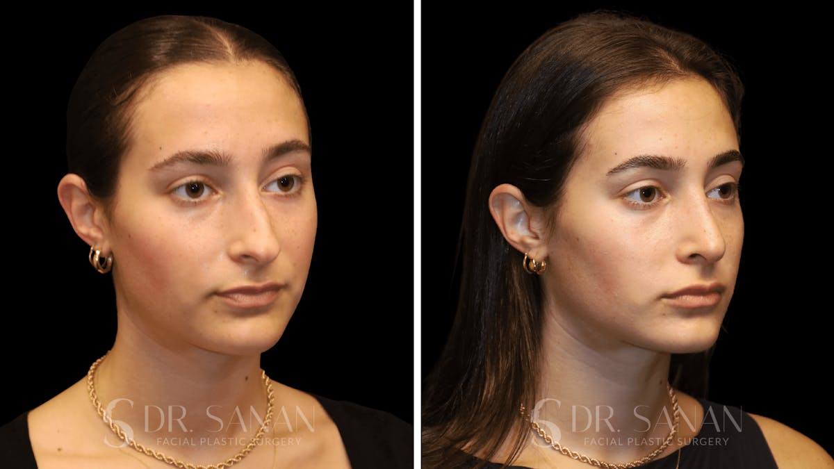 Rhinoplasty Before & After Gallery - Patient 274781 - Image 6