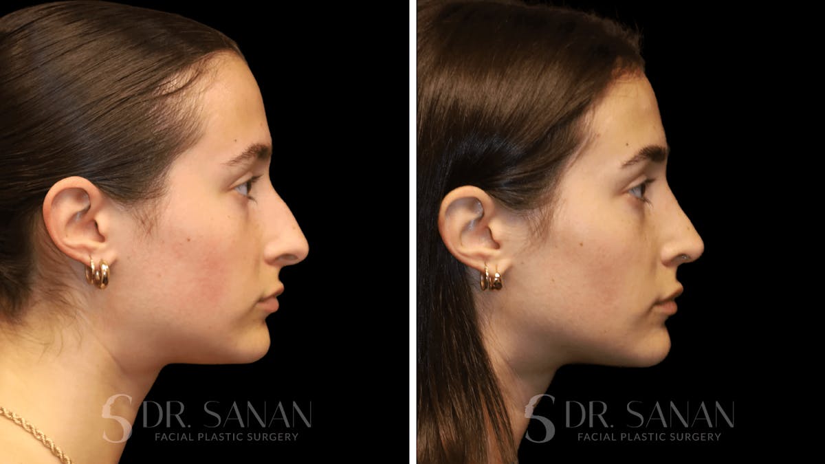 Rhinoplasty Before & After Gallery - Patient 274781 - Image 1