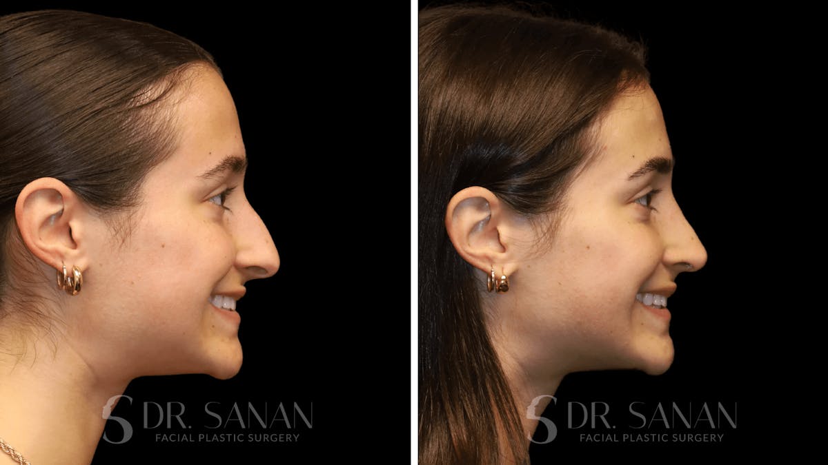 Rhinoplasty Before & After Gallery - Patient 274781 - Image 8