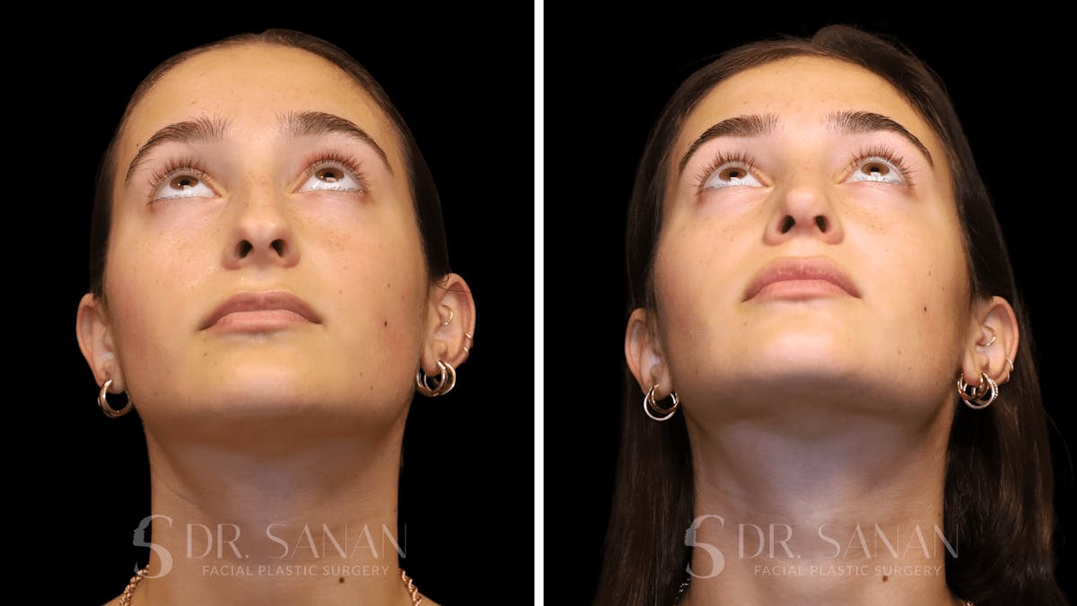 Rhinoplasty Before & After Gallery - Patient 274781 - Image 9