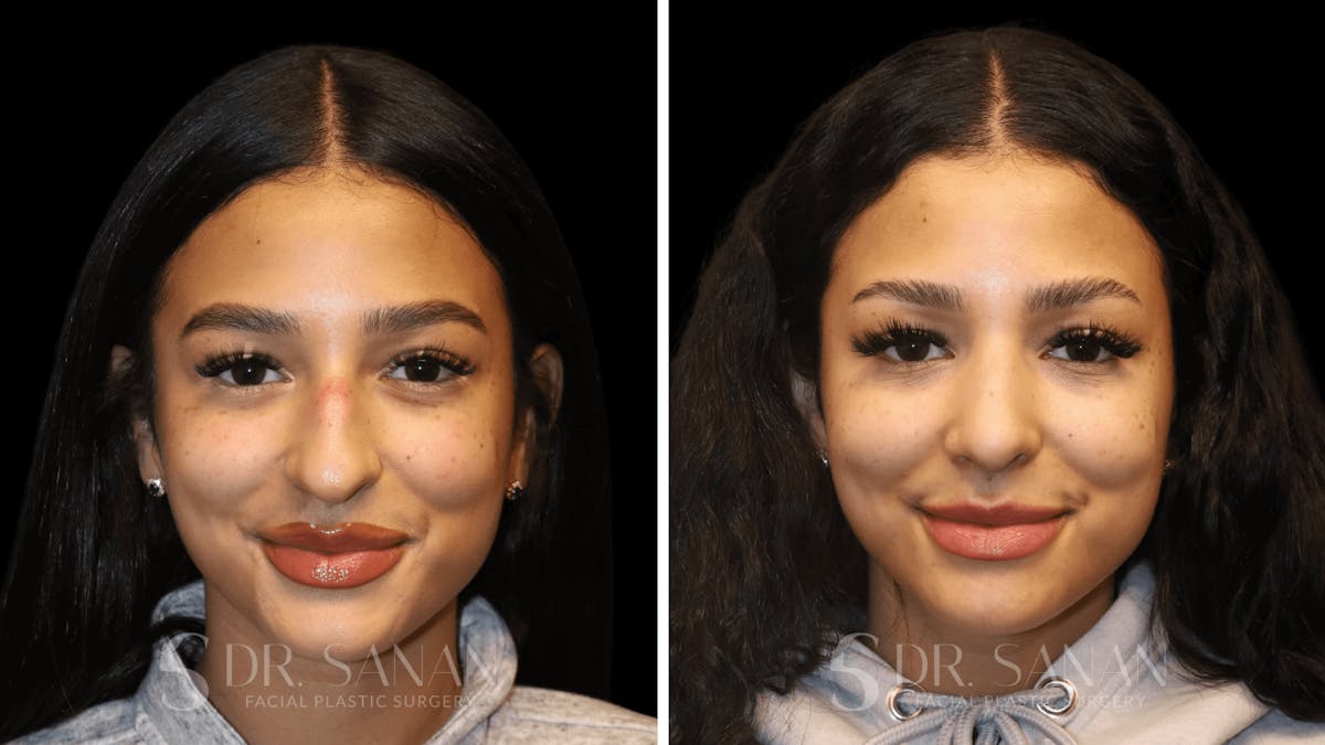 Rhinoplasty Before & After Gallery - Patient 156281 - Image 5