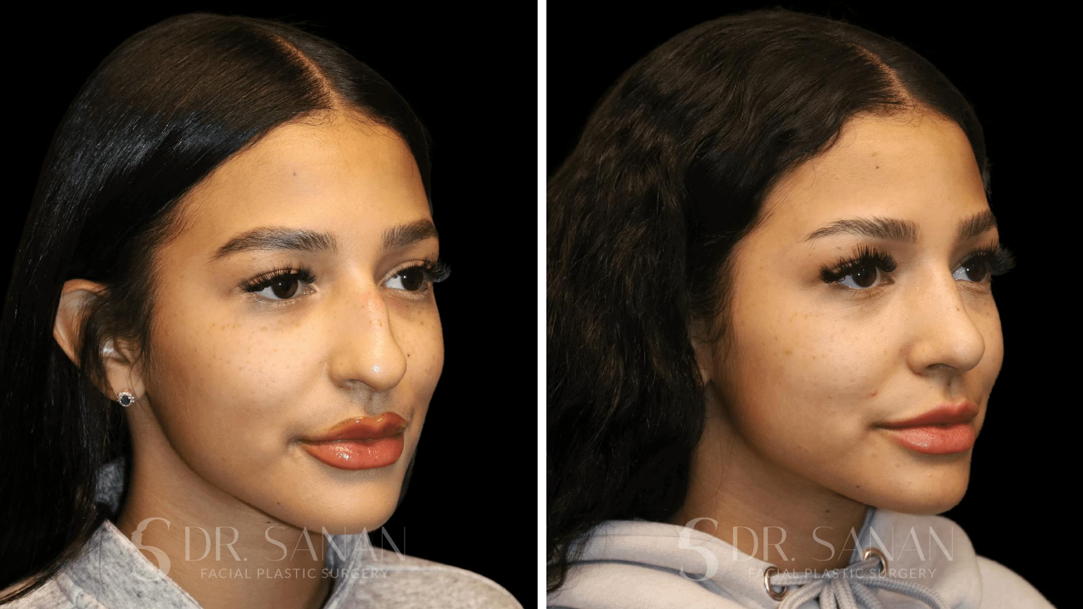 Rhinoplasty Before & After Gallery - Patient 156281 - Image 3
