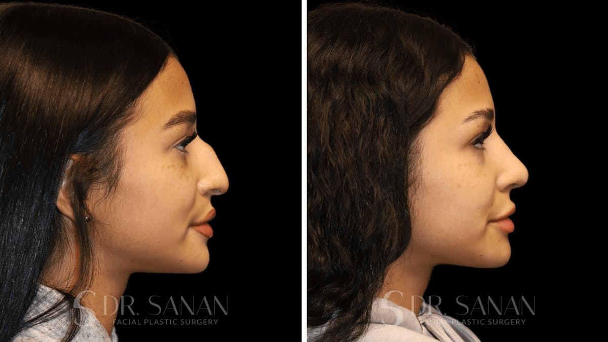 Rhinoplasty Before & After Gallery - Patient 156281 - Image 1