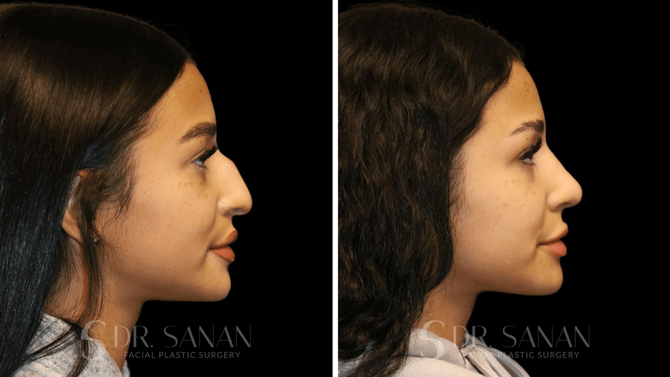 Rhinoplasty Before & After Gallery - Patient 156281 - Image 1