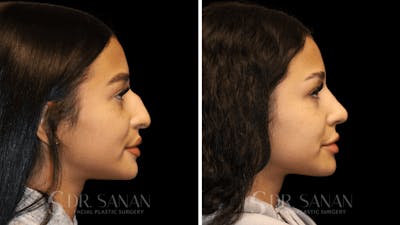 Rhinoplasty Before & After Gallery - Patient 156281 - Image 1