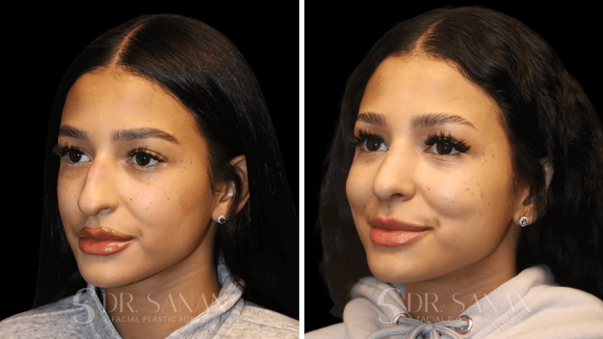 Rhinoplasty Before & After Gallery - Patient 156281 - Image 4