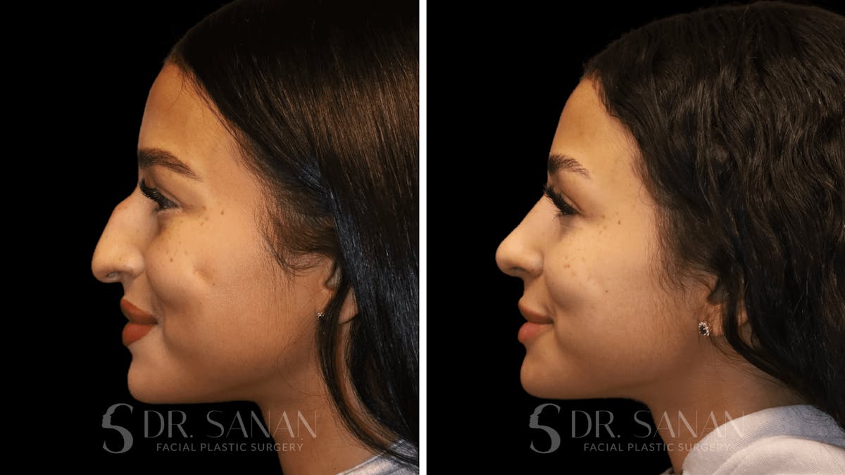 Rhinoplasty Before & After Gallery - Patient 156281 - Image 2