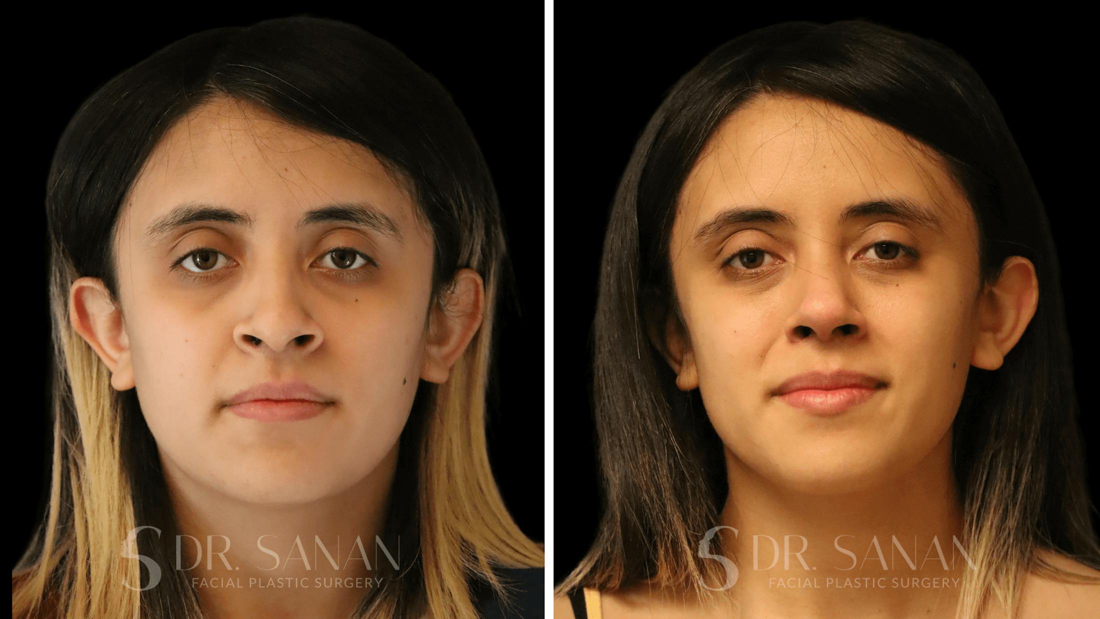 Rhinoplasty Before & After Gallery - Patient 339289 - Image 3