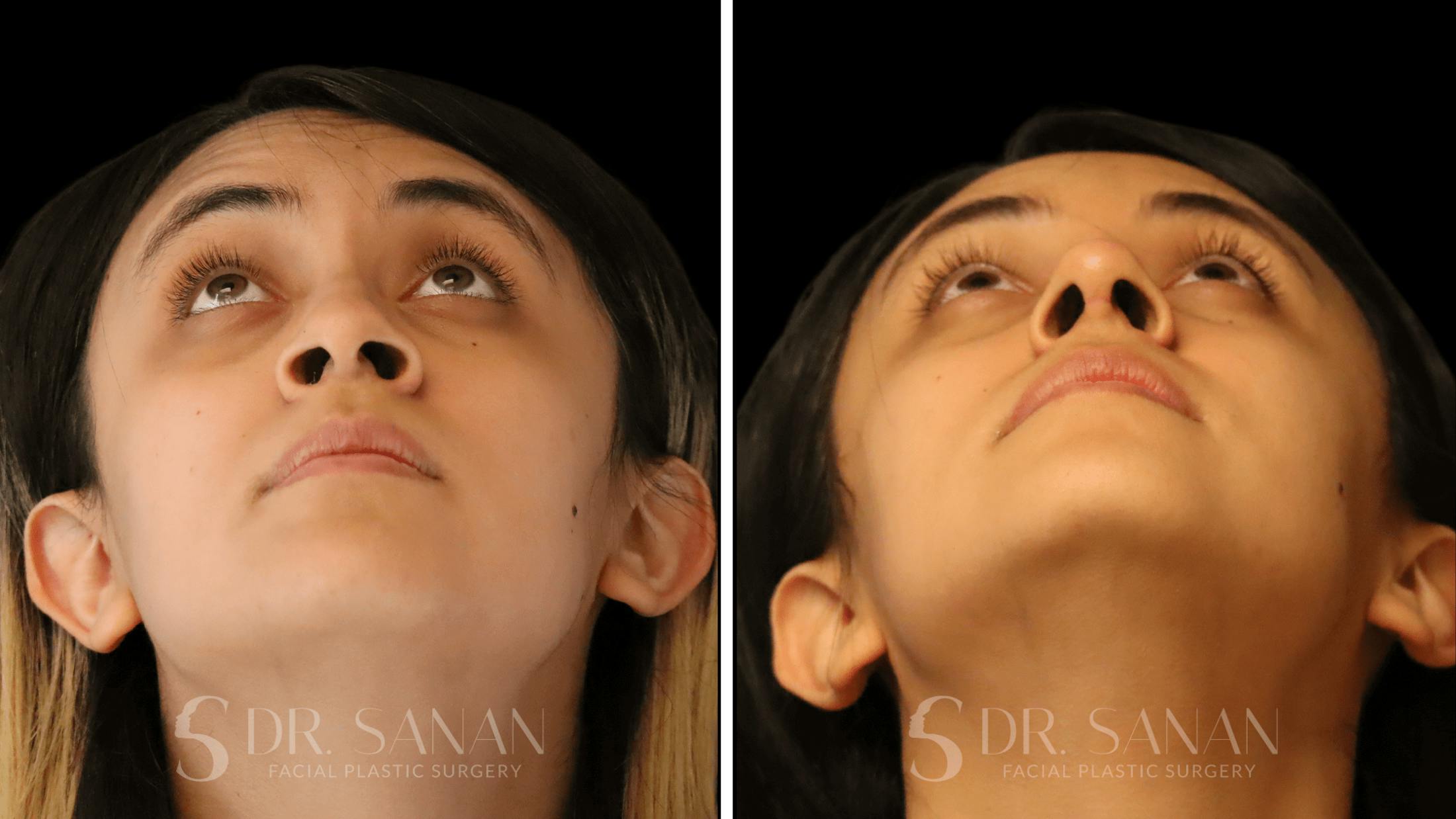Rhinoplasty Before & After Gallery - Patient 339289 - Image 4