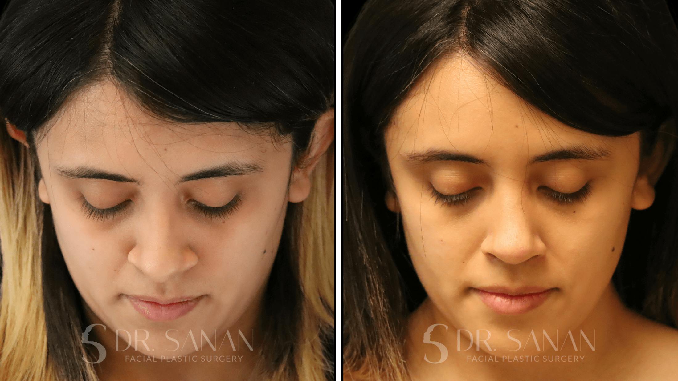 Rhinoplasty Before & After Gallery - Patient 339289 - Image 5