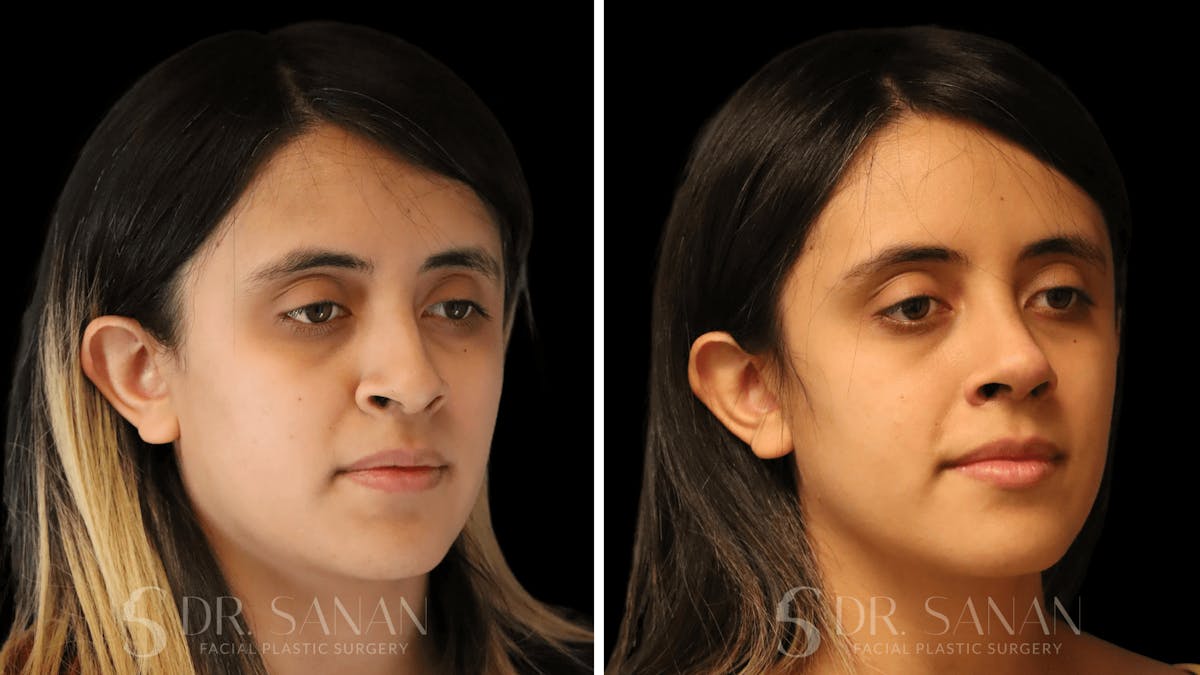 Rhinoplasty Before & After Gallery - Patient 339289 - Image 6