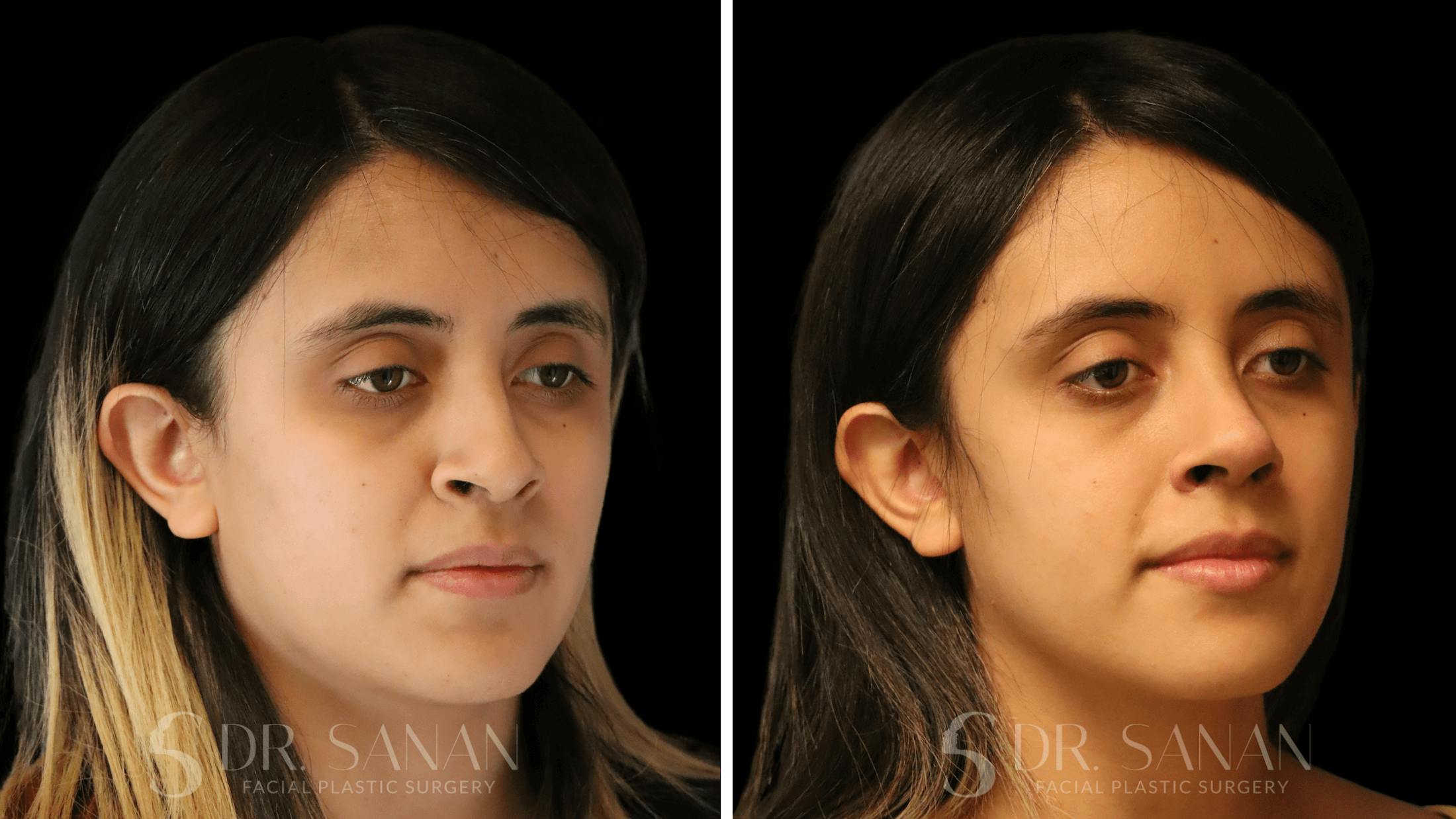 Rhinoplasty Before & After Gallery - Patient 339289 - Image 6