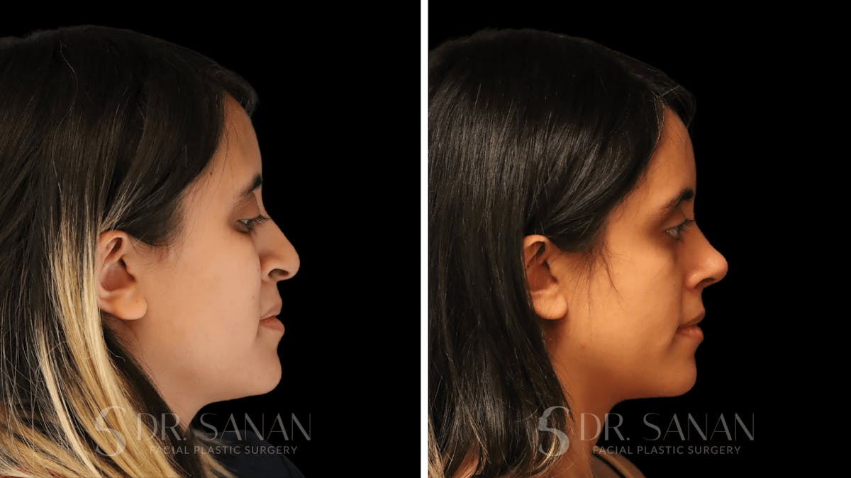 Rhinoplasty Before & After Gallery - Patient 339289 - Image 1